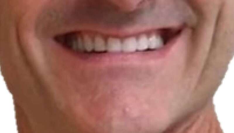 Sonrisa rejuvenecida tras un tratamiento antiaging dental/TA.